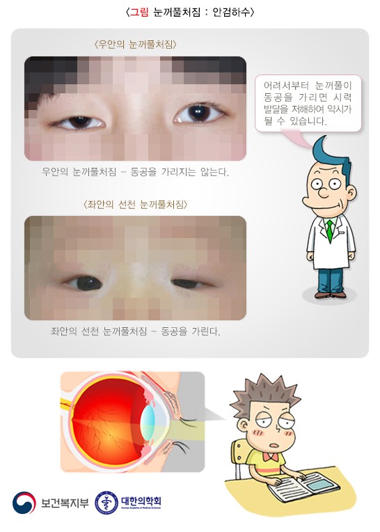 안검하수 안과, 졸려 보이는 눈의 원인에 의한 치료 방법은?