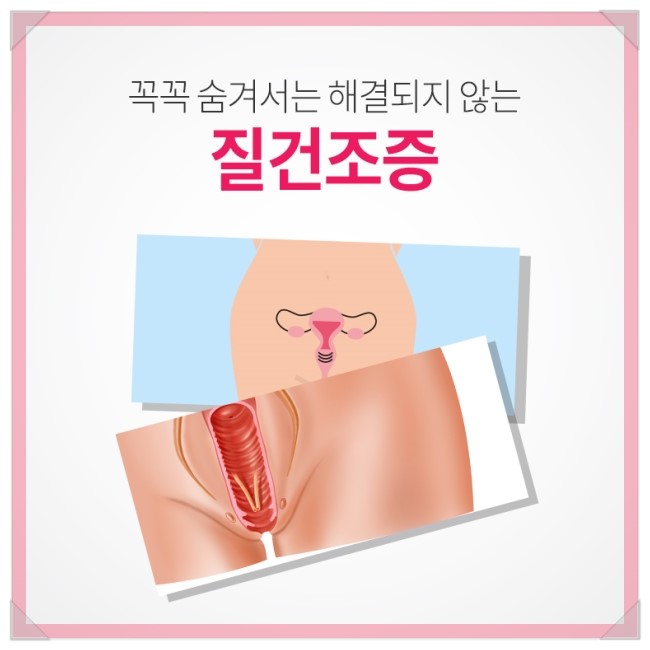 질건조증 나홀로셀프관리 미즈케어 솔루션