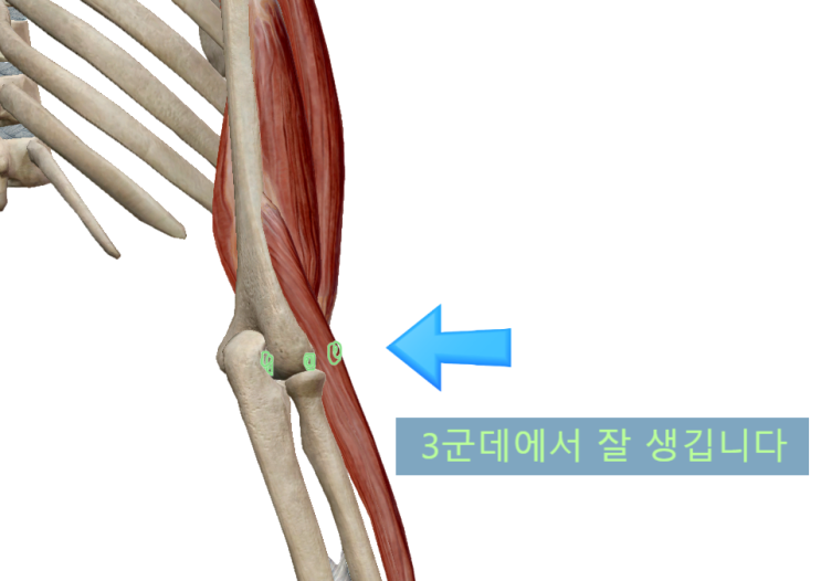 팔꿈치 통증, 엘보가 왔을때?[영통역 새움한의원]