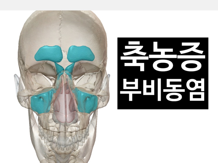 축농증, 부비동염이 두통, 소화불량을 유발합니다.[영통역 새움한의원]