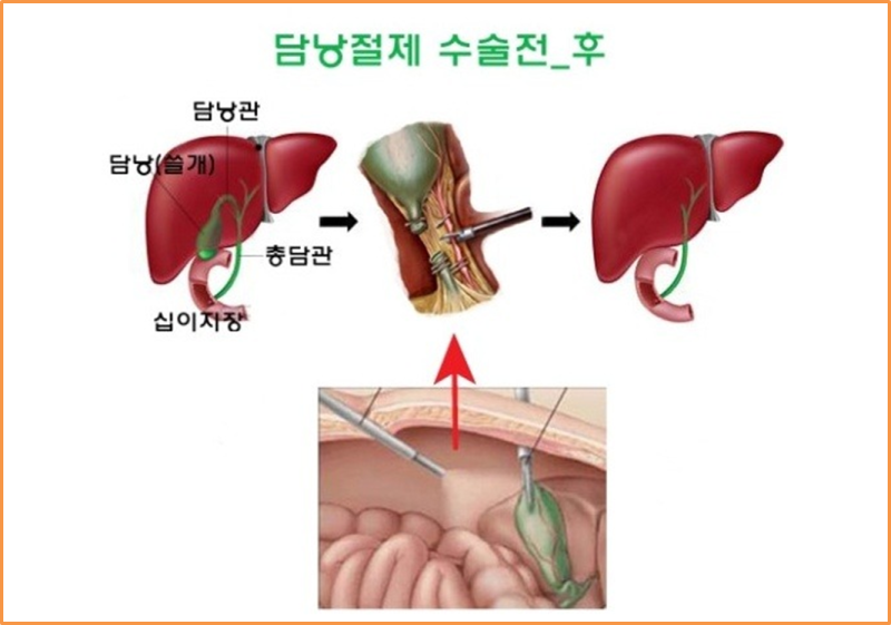 담낭제거수술 후 부작용 : 네이버 블로그