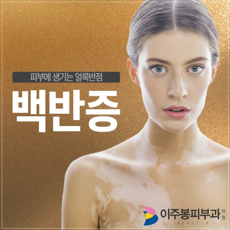  수원 이주봉피부과 , 피부에 생기는 얼룩반점 백반증