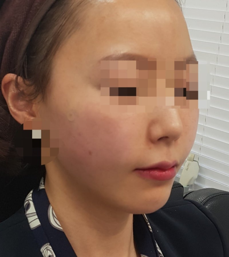 보르스카르트라 효과 및 부작용 리뷰