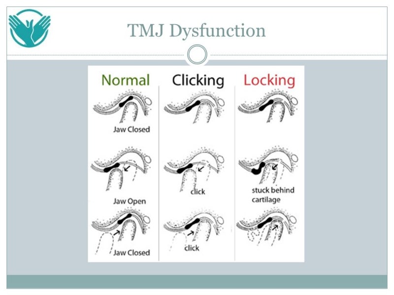 턱 관절(TMJ)의 개요 : 네이버 블로그