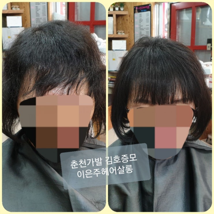  가발혁명!!  김호증모!! 보톡스증모술이 대세