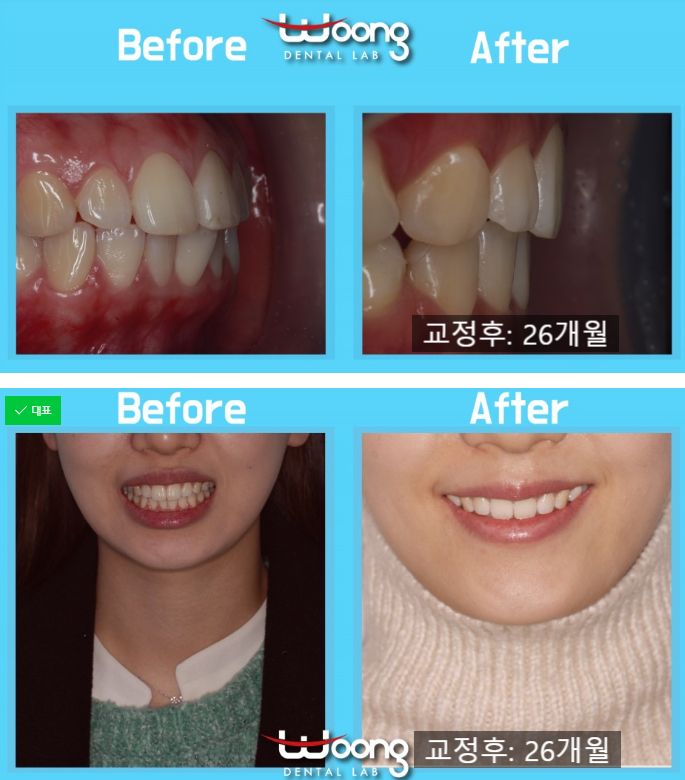  설측교정후기 만족도 좋은 결과를 얻다