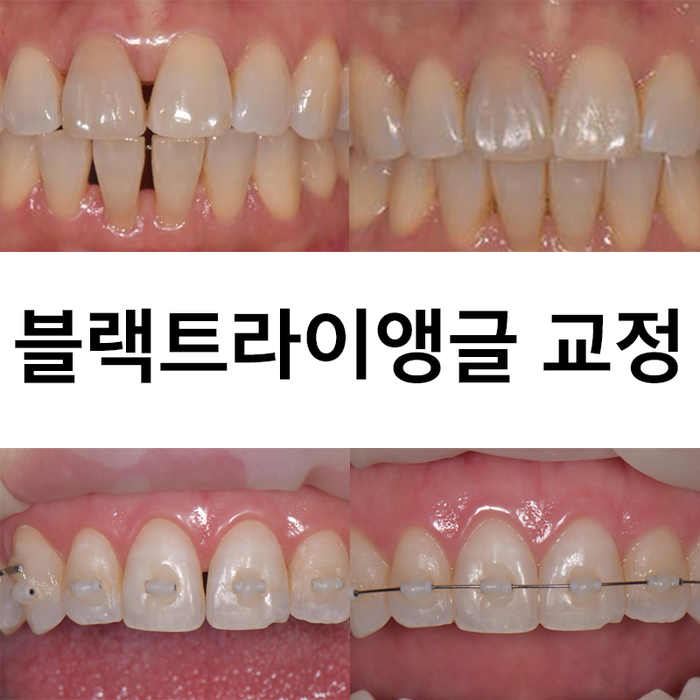  [교대역교정치과 교정전문의] 블랙트라이앵글(Black triangle) 교정