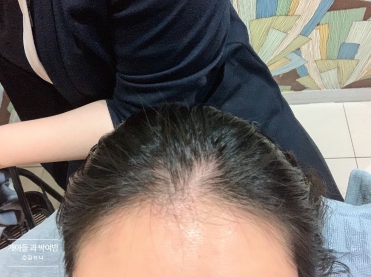 울산탈모클리닉 두피가 비어보이는게 느껴지기 시작하면 6