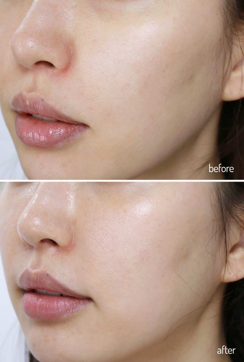 집에서 하는 아쿠아필 디바이스 ☆ 엔시트론 아쿠아바이탈케어 : 네이버 블로그