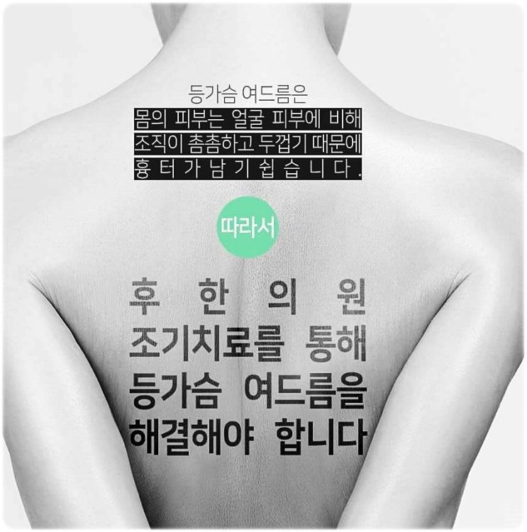  울산등여드름 이제는 개선해보자! 