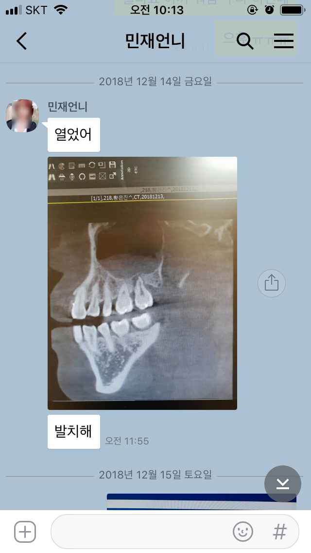 임산부 어금니 발치 :: 임신16주차 드디어 발치 1