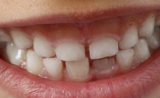 치아성형으로 짧은 기간 안에 앞니를 가지런하게 교정을 하다.