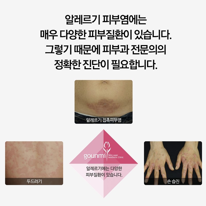 대구 습진 치료제. 홍반이 심할 때