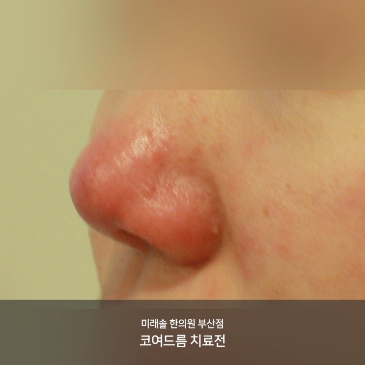  코여드름 계속 커져만 가는데