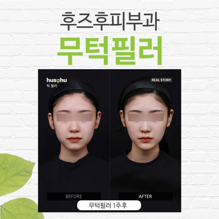  무턱필러 갸름해졌어요