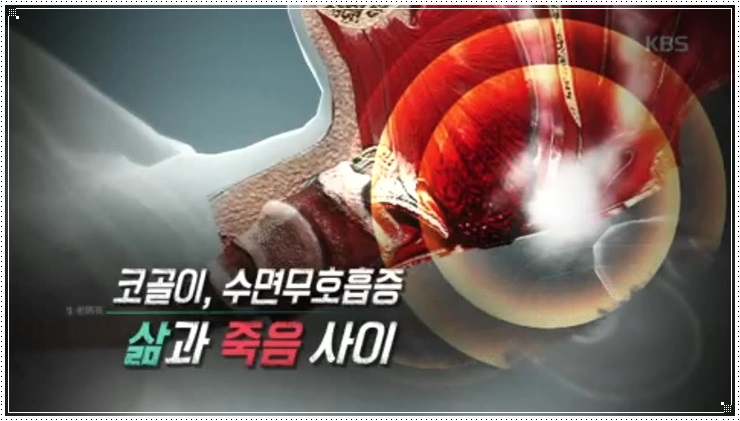  생로병사의 비밀 코골이 수면무호흡증을 보고
