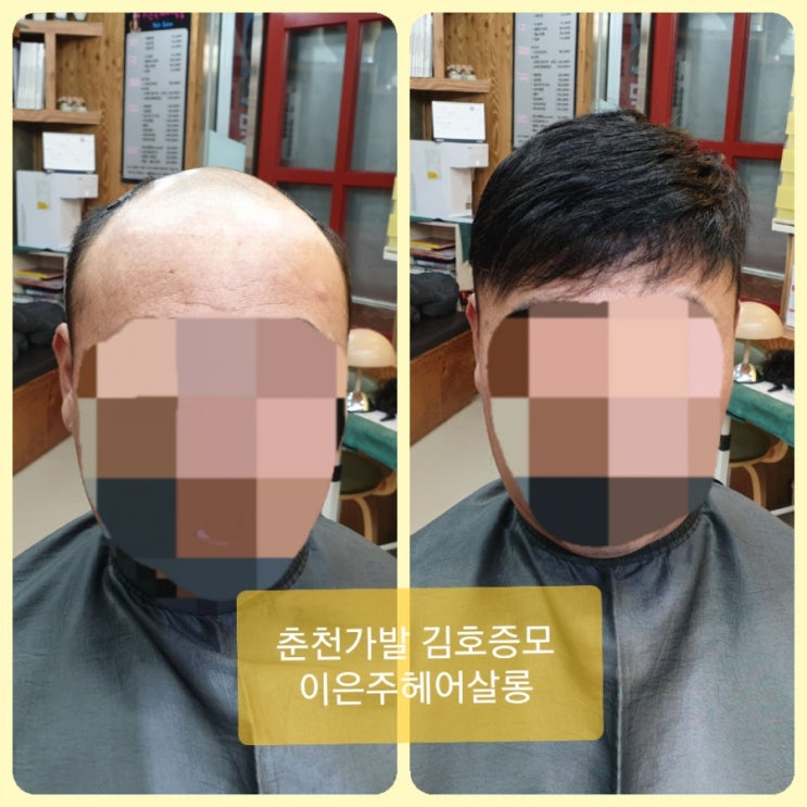  반고정식 남자맞춤가발 춘천가발 김호증모 이은주헤어살롱
