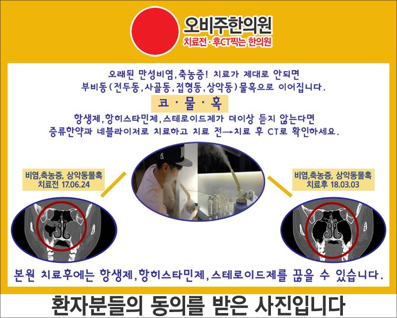 축농증명의 만성이라도 끝낼 수 있어요