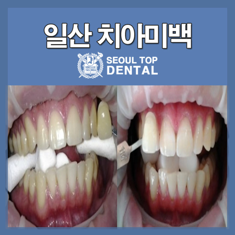 일산톱치과 원데이치아미백으로 자신있는 미소를 찾으세요~ 고양시 원데이치아미백치과