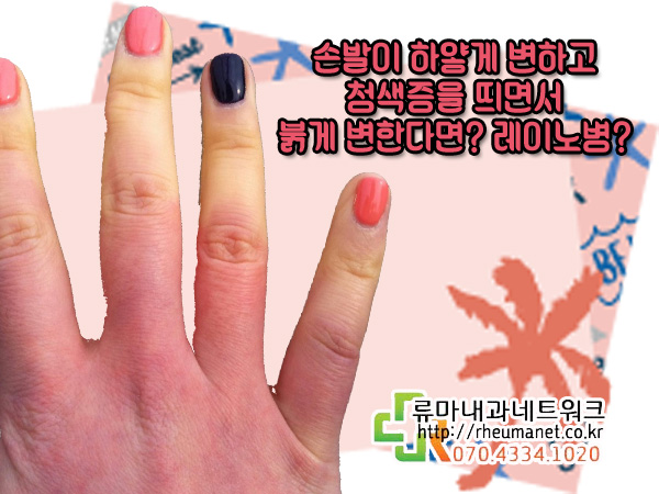  수족냉증 레이노병 차이점과 치료 어디서 받아야 하나요?