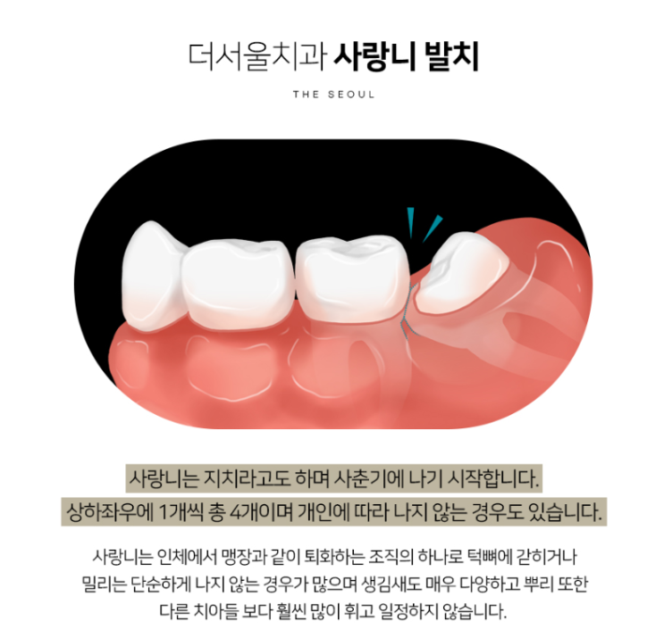  사랑니 발치는 성남치과 <더서울치과>에서 경험 많은 치과의사에게 받아보세요!