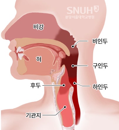 비인두암 초기증상, 인후이물감, 쉰목소리, 코막힘의 원인예방방법 12