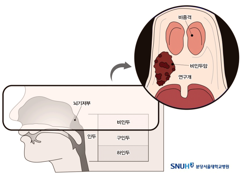 비인두암 초기증상, 인후이물감, 쉰목소리, 코막힘의 원인예방방법 14