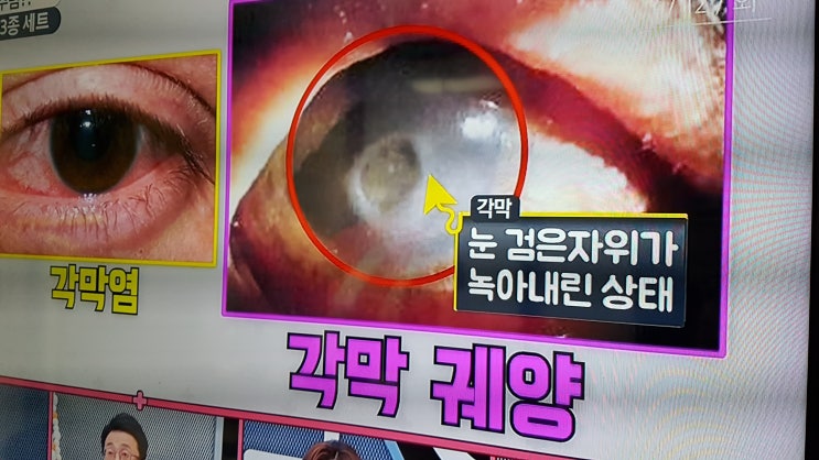  해마토코쿠스가 녹내장 배한성씨 눈을 보호해요