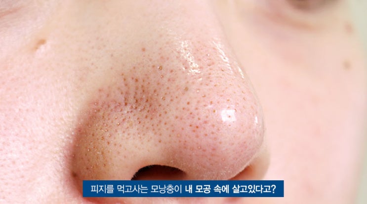  얼굴 모낭충 제거 자극없이 말끔하게 케어 大성공