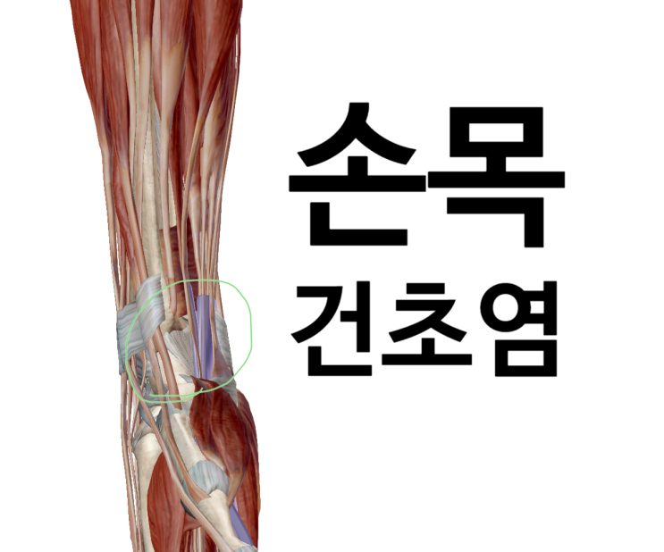 손목통증, 드퀘르벵 증후군. 손목이 아니라 팔꿈치를 치료합니다[영통역/서천동 한의원]