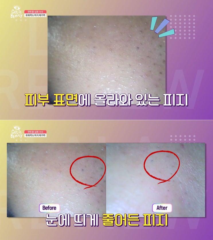  얼굴 모낭충 제거 피지&여드름 효과적으로 해결 성공