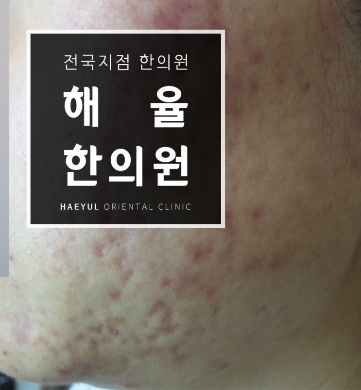  볼여드름흉터 이제그만 사라져라