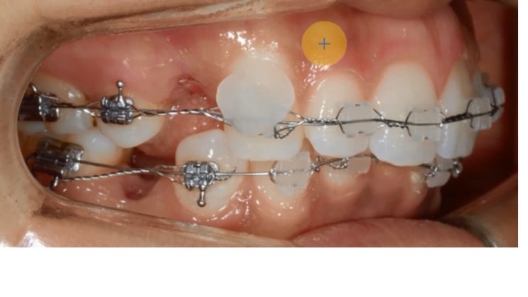 [치아교정] 치아교정용 왁스 꼭 챙기세요! (없으면 불편합니다)
