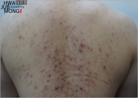  대전등여드름치료 여름이 두렵다면