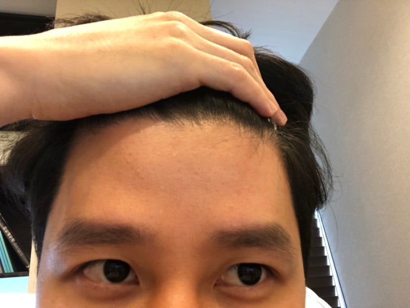 이마 보톡스 시술의 주름 효과 주기와 가격 및 부작용은? 9