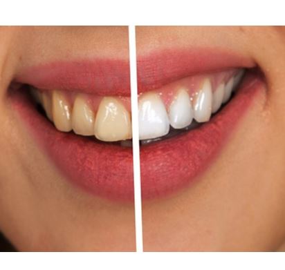 치과 마다 치아미백 가격이 차이가 있는 이유는?