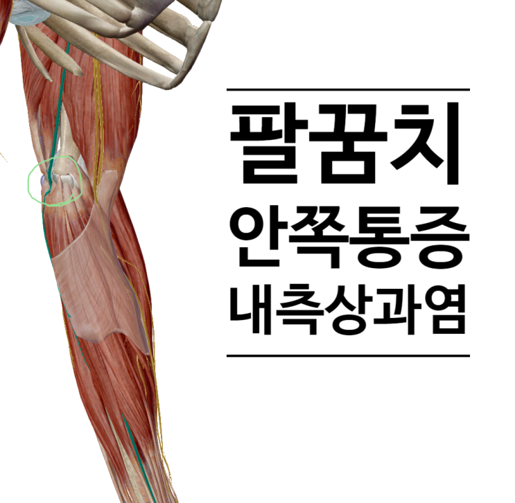 팔꿈치 안쪽 통증, 골프엘보 [영통 새움한의원]