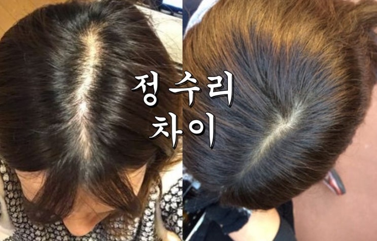  안정환탈모약 : 카필러스 : 45일 쿠라코마에 샴푸