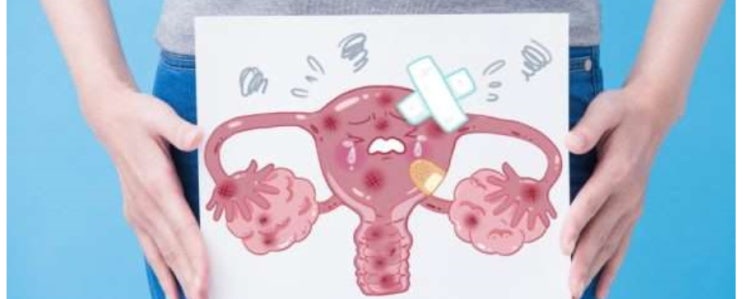  자궁을 지켜라…여성 생식기 종양 치료하려면?