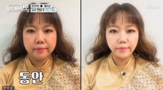  아내의 맛) 홍현희제이쓴 성형외과방문 견적 받기ㅋㅋㅋ