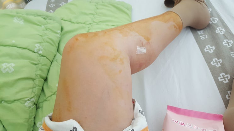  해운대백병원 하지정맥 수술후기! 하나도 안아팠어!