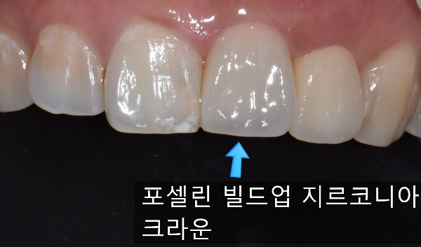  넘어져서 깨진 앞니 지르코니아 크라운 치료 방법에 대해 알아봅시다.