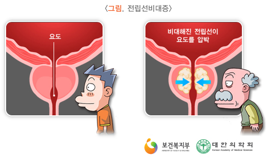 전립선비대증약 부작용 경험기 (+영양제) 5