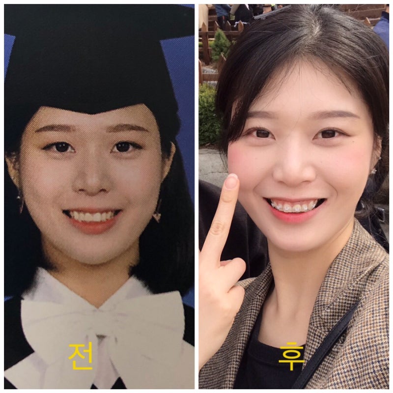 치아교정 발치 후기 고통(한꺼번에 4개뽑음)+스크류+거즈 삼킴 : 네이버 블로그 치아교정 발치 후기 고통(한꺼번에 4개뽑음)+스크류+거즈 삼킴 : 네이버 블로그
