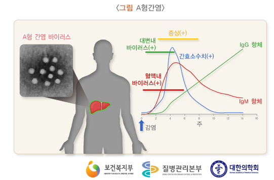  (방배동 소아과) A형 간염 바이러스(Hepatitis A virus)에 의한 급성 감염 질환 