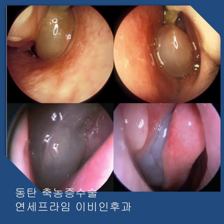 동탄축농증 섬세한 관리로