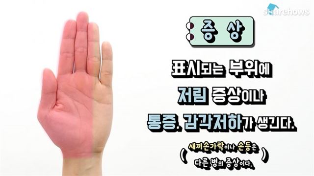 '손목터널증후군' 자가진단과 예방운동