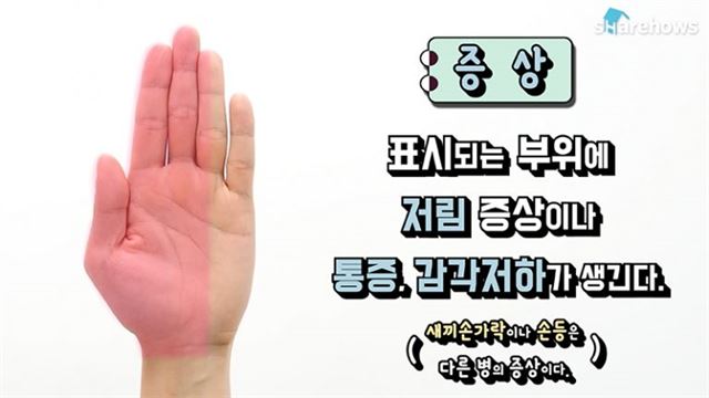  '손목터널증후군' 자가진단과 예방운동