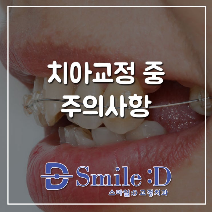  강남치아교정 교정 중 주의사항