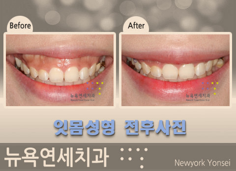  치과에서 잇몸성형 치료를 계획한다면 이런 부분은 꼭 참고하세요!